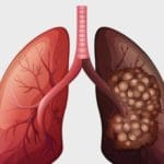 Ups! Ternyata Asbes Dapat Memicu Seseorang Mengidap Kanker Paru