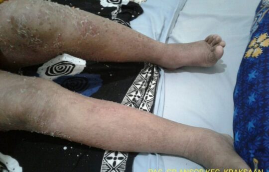 Sakit 4 tahun, Warga Semampir Ini Butuh Bantuan