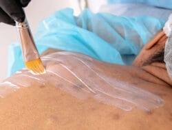 Cara Menghilangkan Jerawat di Punggung Secara Alami dan Efektif