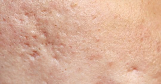 MOLD Manila Unveils PRP Therapy: A Revolutionary Approach to Revitalize Your Skin’s Natural Glow